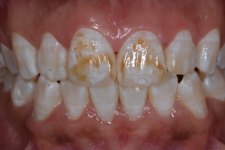 Engolir creme dental faz mal?