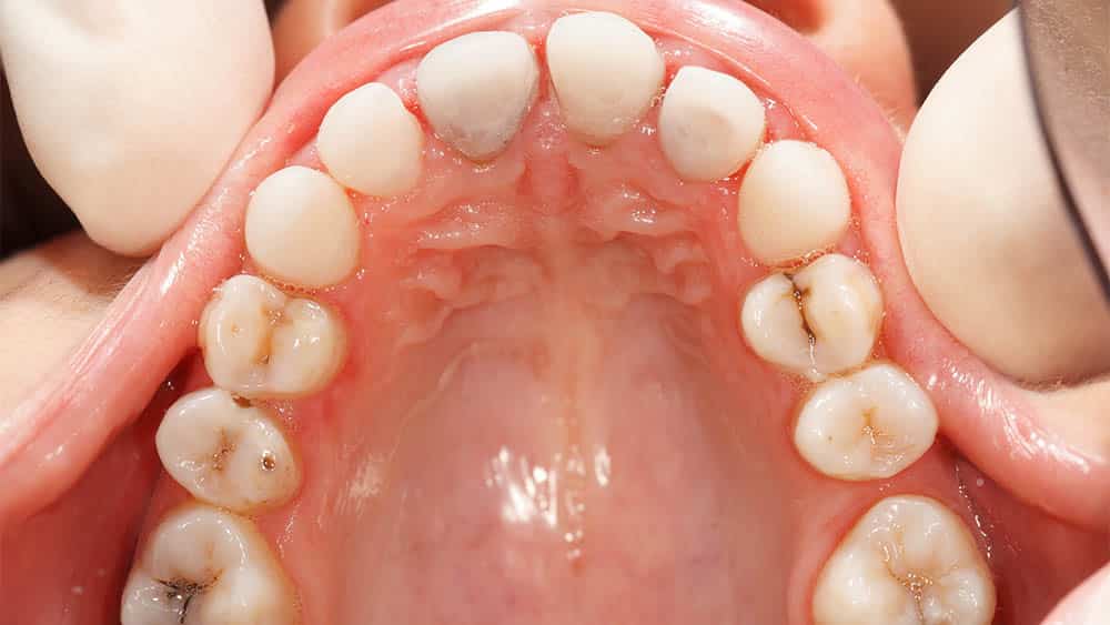 O que é a cárie?