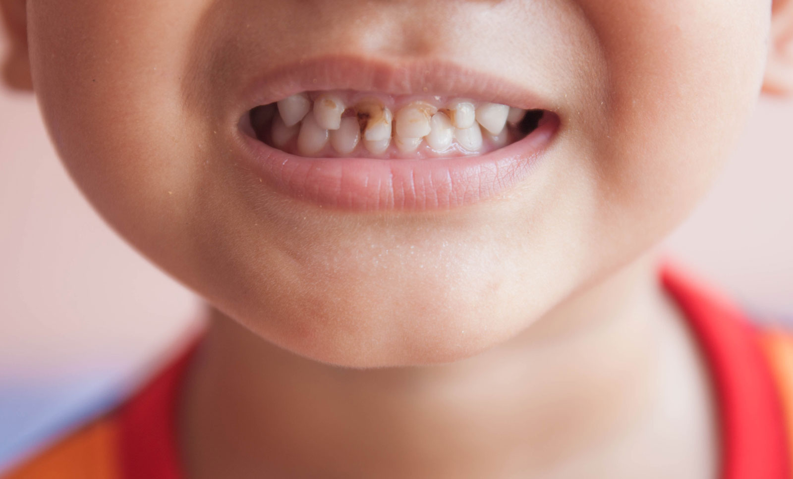 Meu filho está com cárie no Dentinho!