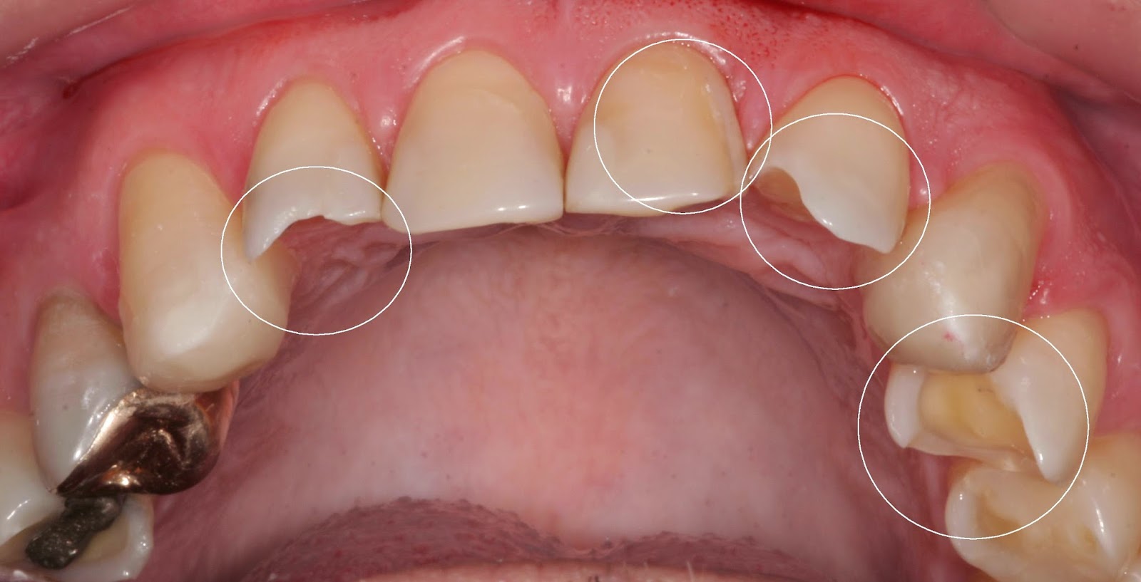 O que provoca erosão nos dentes?