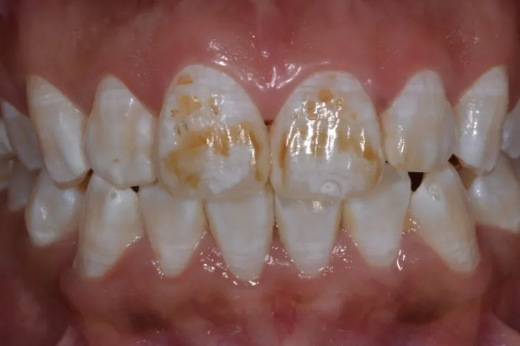 Engolir creme dental faz mal?
