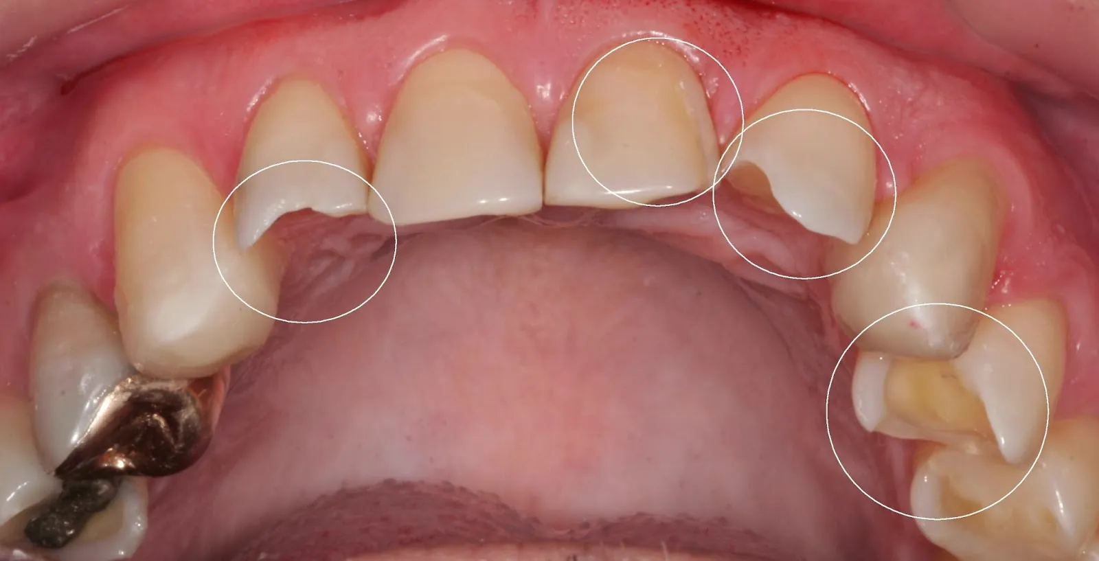 O que provoca erosão nos dentes?