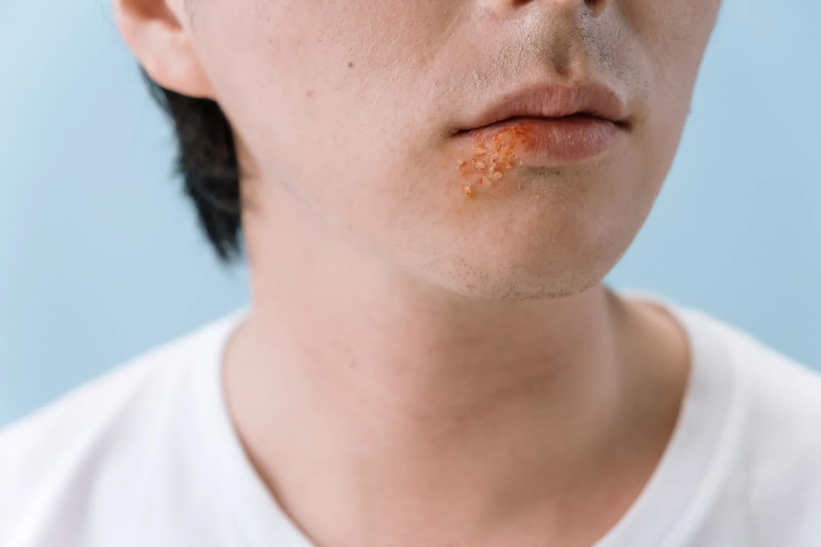 O que é herpes labial?