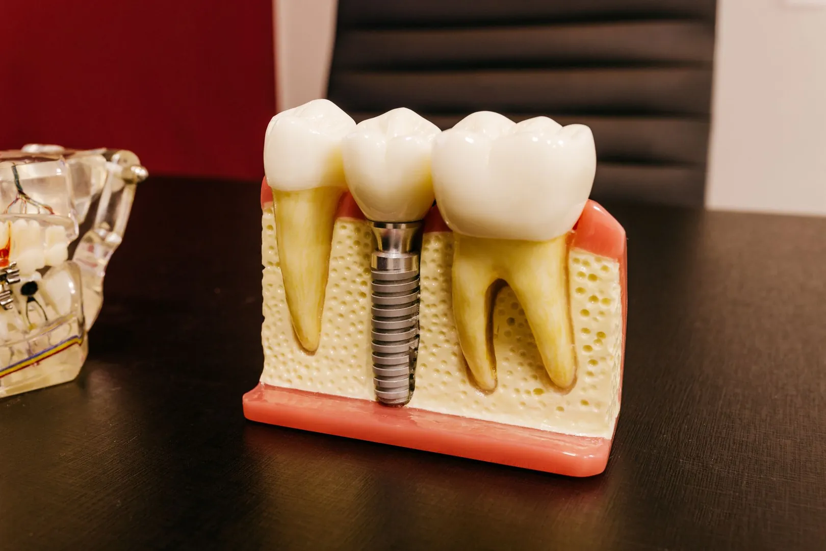 Implante dentário