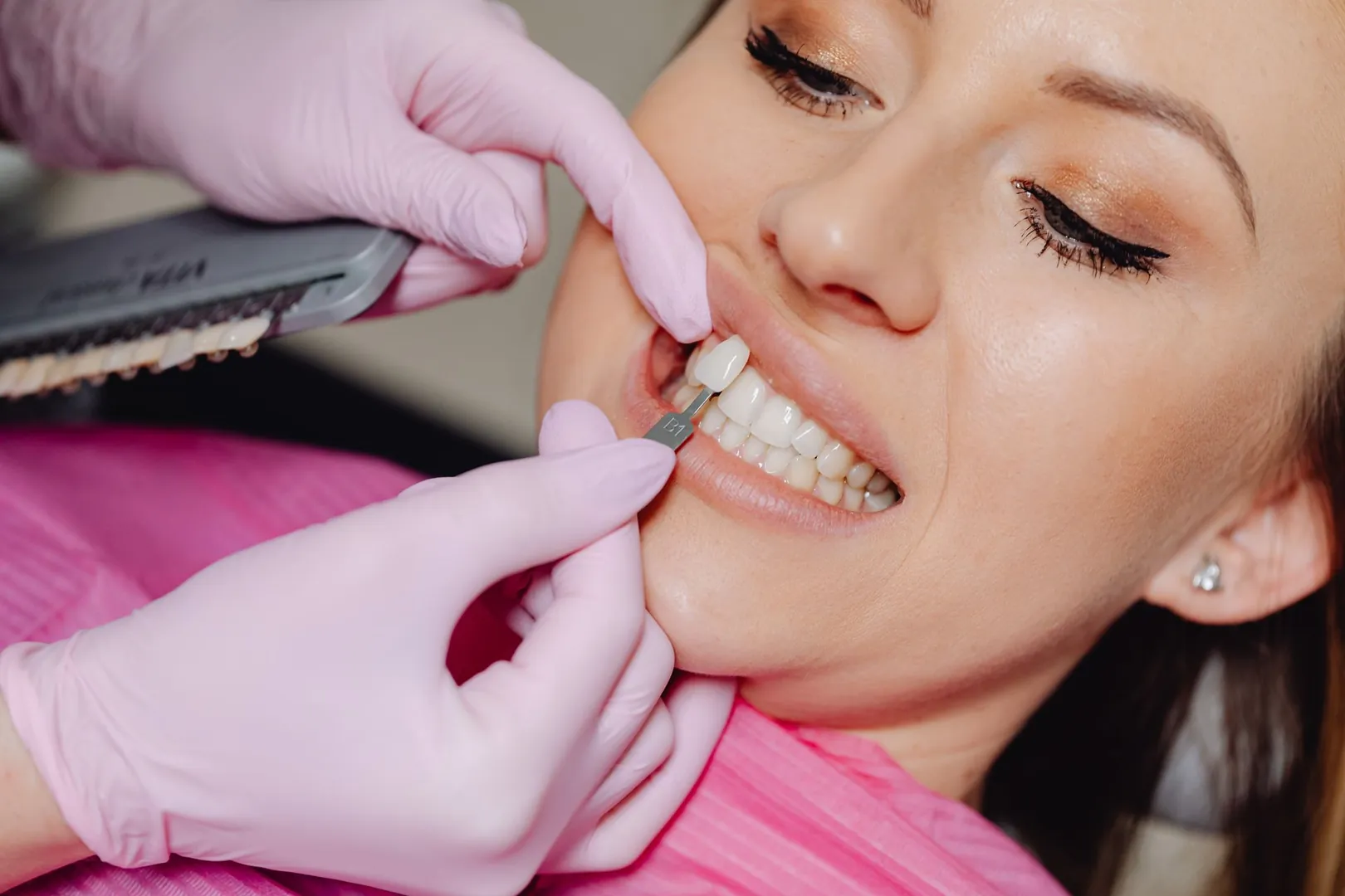 Lente de Contato Dental